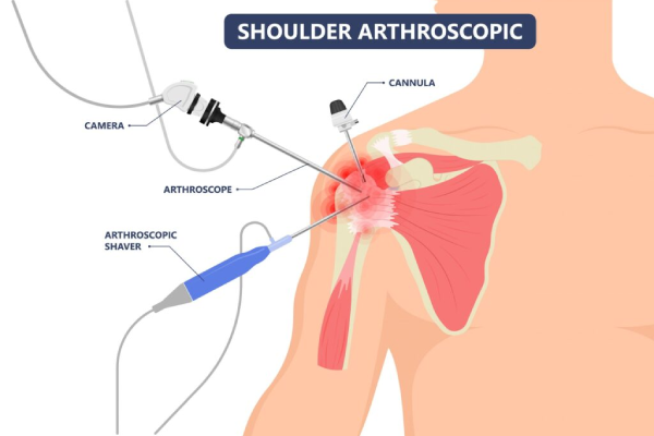 Healing From Within: Are Mesenchymal Stem Cells the Future for Rotator Cuff Repairs