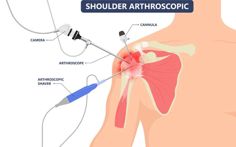 Healing From Within: Are Mesenchymal Stem Cells the Future for Rotator Cuff Repairs