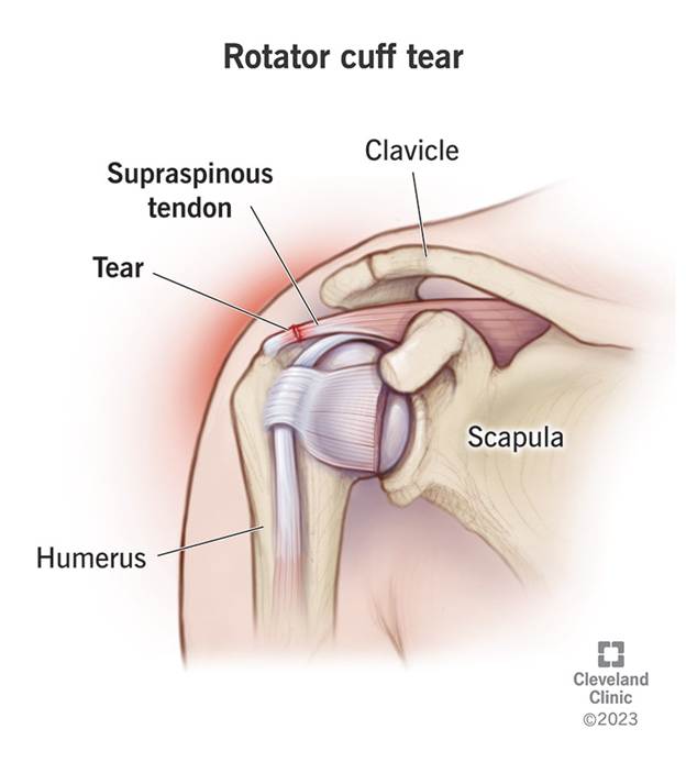 A diagram of a rotator cuff tear.
