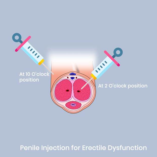 A diagram of a penile injection

AI-generated content may be incorrect.