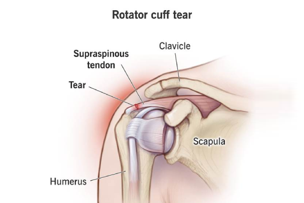 Hair Restoration Therapy with MSCs and PRP