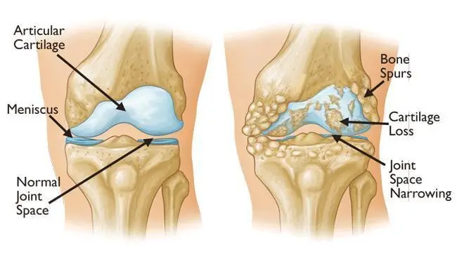 A diagram of a rotator cuff tear.